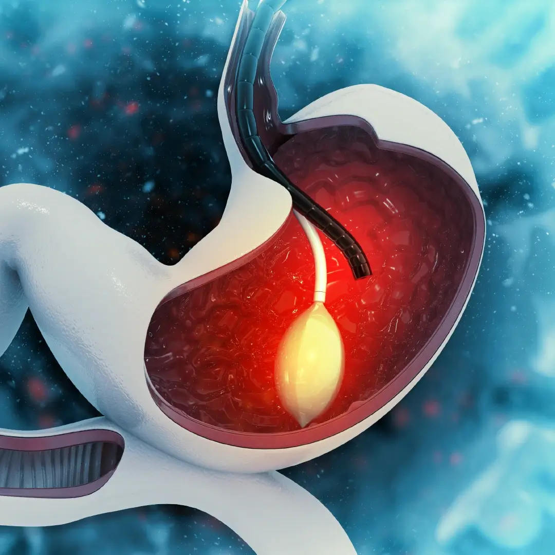 Upper Endoscopy EGD