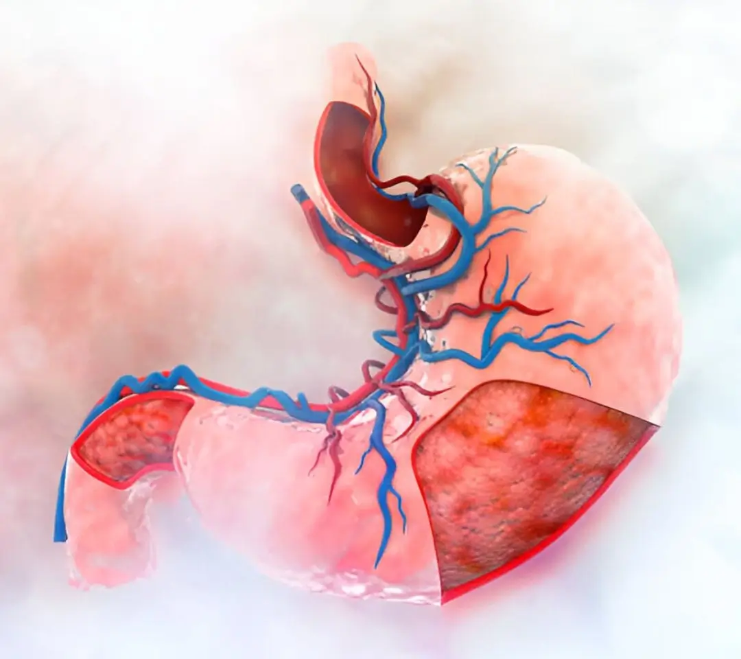 Esophageal & Gastric Variceal Banding