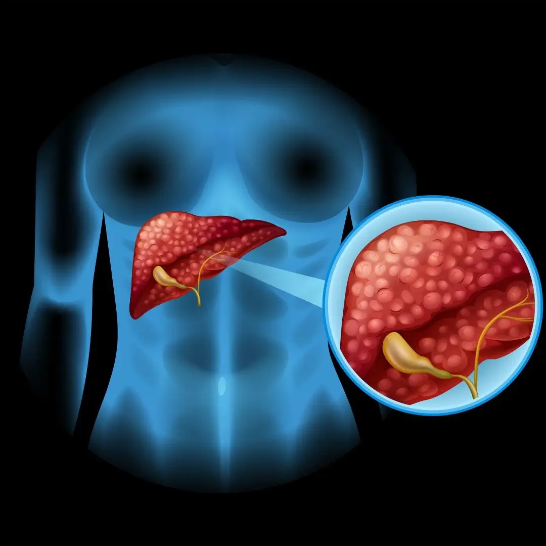 Fatty Liver Disease Treatment