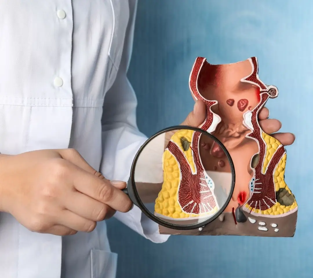 Hemorrhoid Banding (CRH O’Regan System)