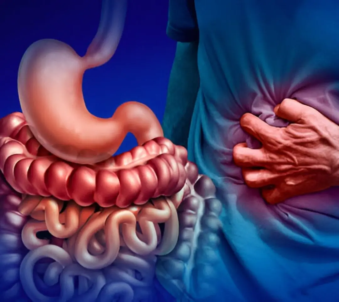 Crohn’s Disease & Ulcerative Colitis Management