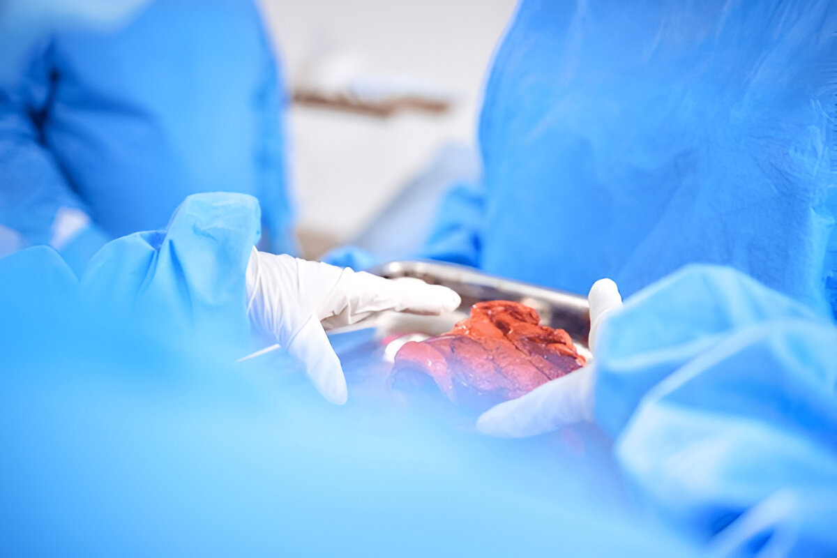 Liver Transplantation