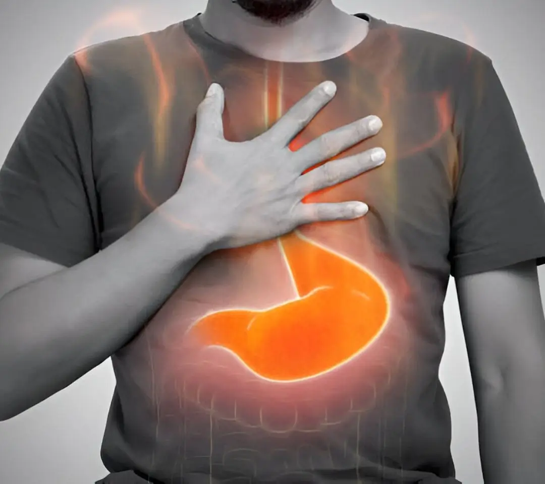 GERD Treatment