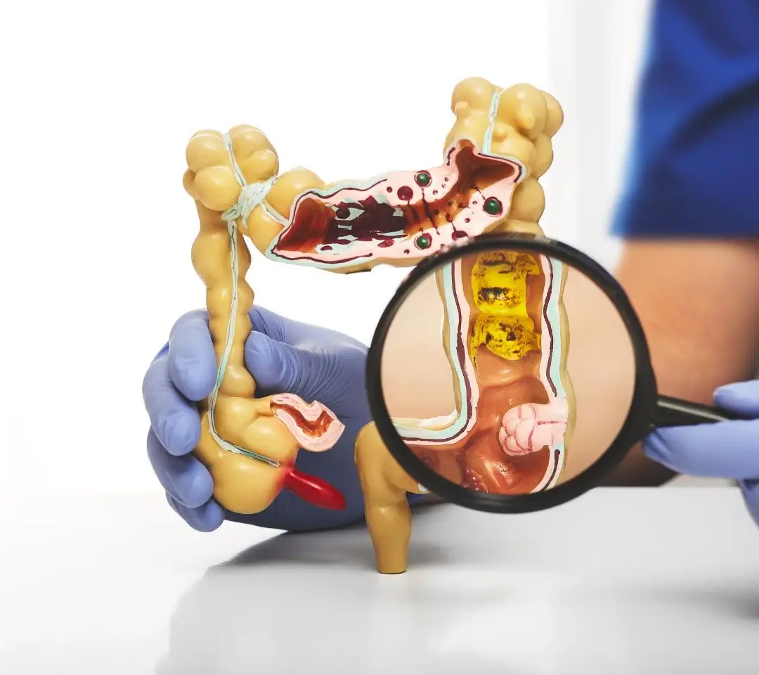 Diverticulitis Treatment